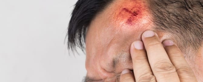 Signs and Symptoms of a Head Injury
