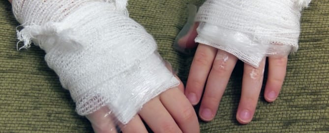 How to Treat Burns and Scalds